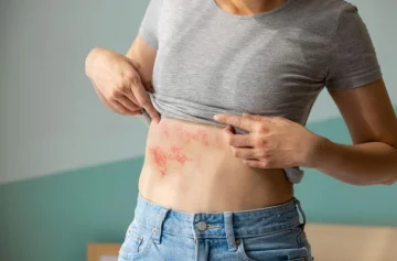 Mes de Concientización del Herpes Zóster: riesgos y prevención