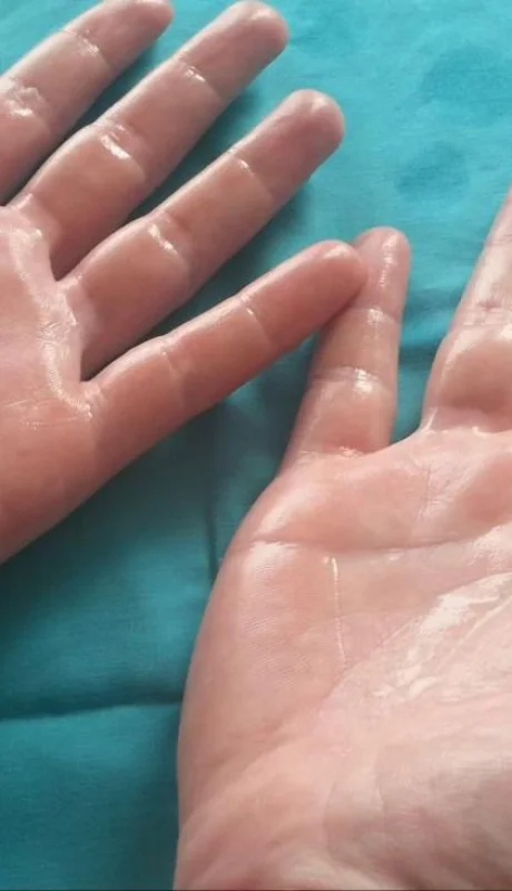 transpiracion-hiperhidrosis-png.