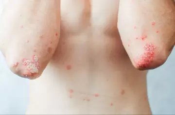 Psoriasis pustulosa generalizada: síntomas y tratamiento