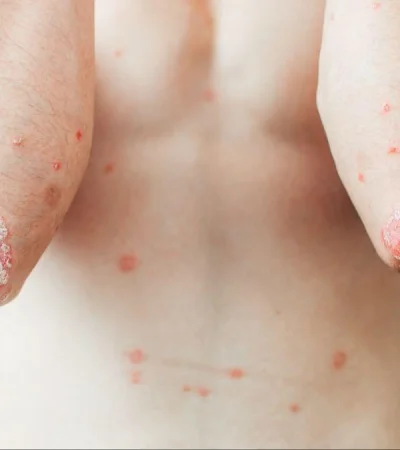 psoriasis-pustulosa-generalizada-2-png.