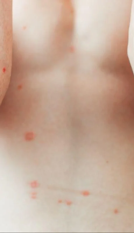 psoriasis-pustulosa-generalizada-2-png.