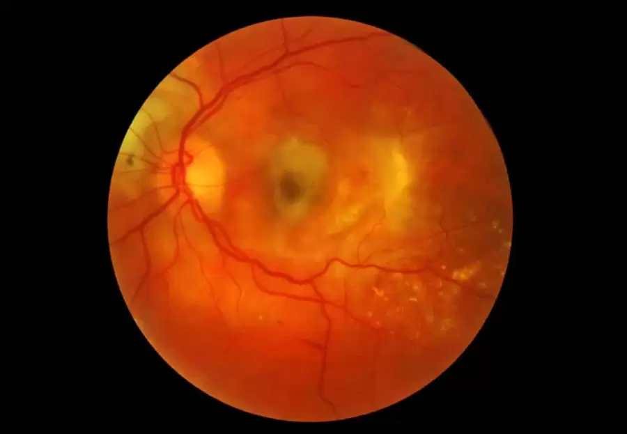 Edema macular