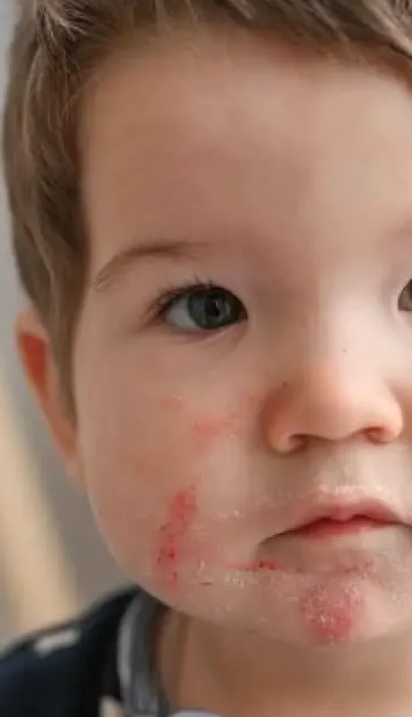 alergia_alimento_nino