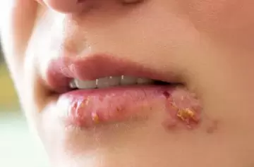 Las personas con enfermedades respiratorias son más propensas al herpes