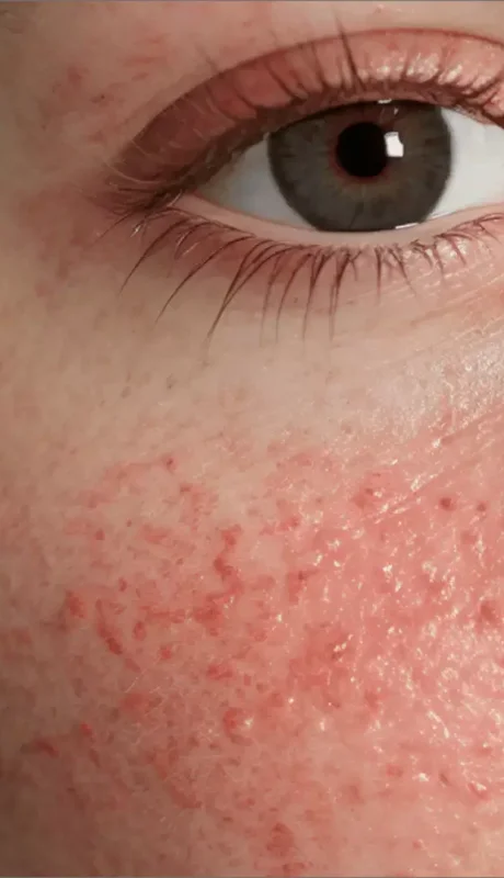 Lupus eritematoso sistémico