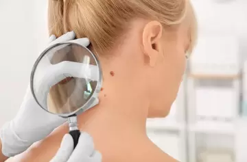 Cirugía de Mohs: la técnica avanzada para tratar el cáncer de piel