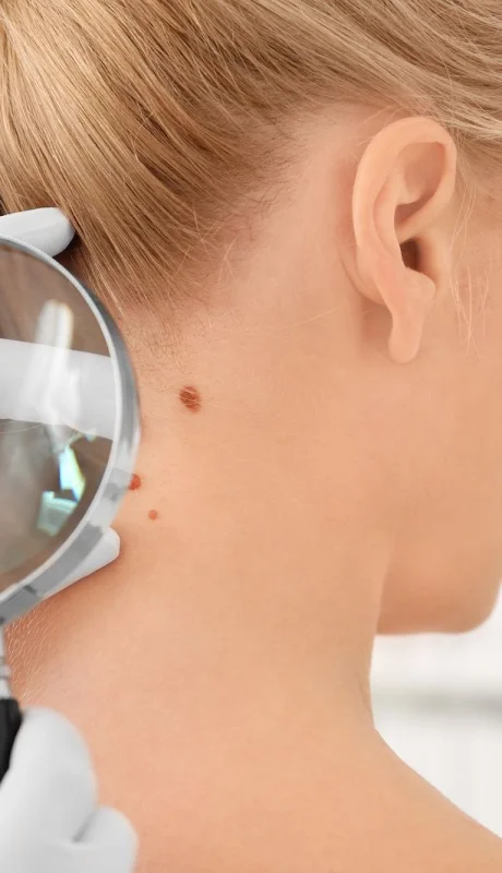 Cirugía de Mohs: la técnica para el tratamiento del cáncer de piel que se realiza en un solo día.