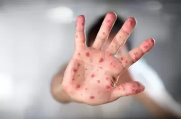 Enfermedad frecuente complica la vida de las personas, pero aseguran que tiene cura