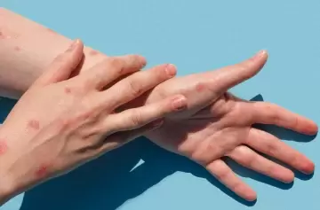 Viruela del mono: una nueva cepa más letal acosa a África