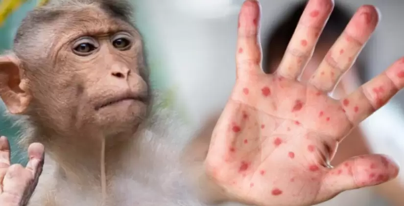 La Organización Mundial de la Salud (OMS) declaró que la Mpox, también conocida como viruela del mono, representa una emergencia sanitaria.