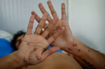 La Viruela del Mono pisa el territorio argentino con un primer caso en San Isidro