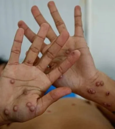 Se confirmó el primer caso de viruela del mono en Argentina