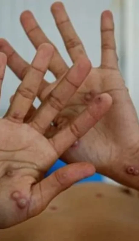 Se confirmó el primer caso de viruela del mono en Argentina