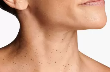 ¿Por qué salen verrugas en el cuello? La ciencia detrás de este incómodo problema