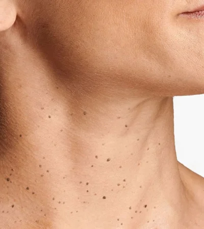 ¿Por qué salen verrugas en el cuello? La ciencia detrás de este incómodo problema