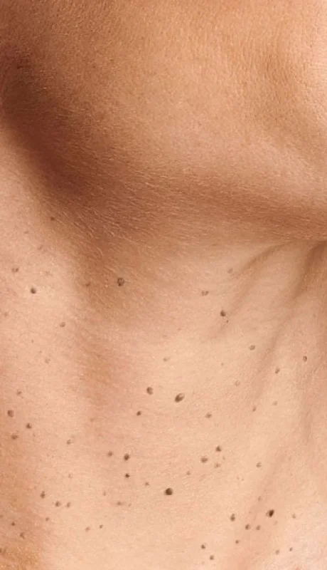 ¿Por qué salen verrugas en el cuello? La ciencia detrás de este incómodo problema