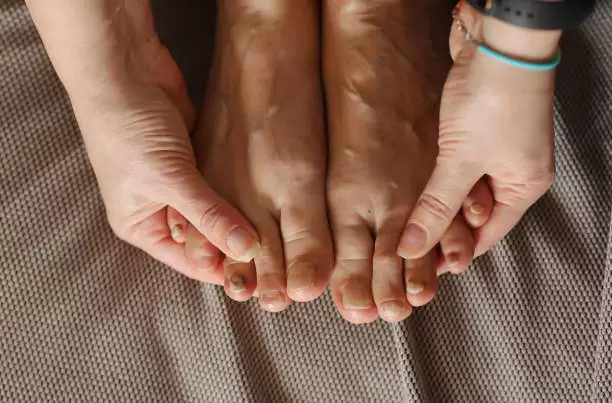 Hongos en las uñas de los pies.