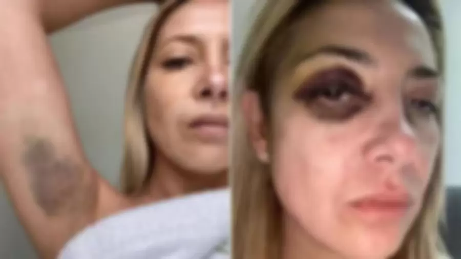 La exprimera dama aportó fotos que muestran probables golpes del denunciado. (Foto: web)