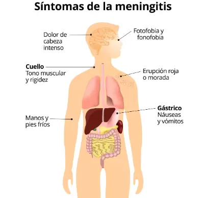 Reconocer los síntomas de la meningitis es fundamental para recibir atención médica de inmediato y un tratamiento eficaz.