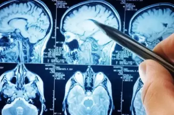 Alzheimer: cerca de la mitad de las demencias se pueden prevenir