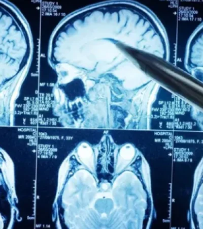 En Argentina, el Alzheimer afecta a cerca de 300.000 personas y es la quinta causa de muerte.