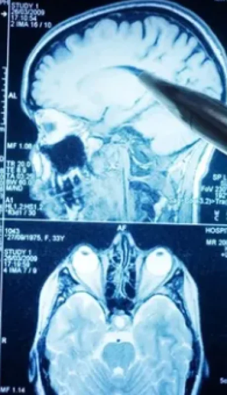 En Argentina, el Alzheimer afecta a cerca de 300.000 personas y es la quinta causa de muerte.