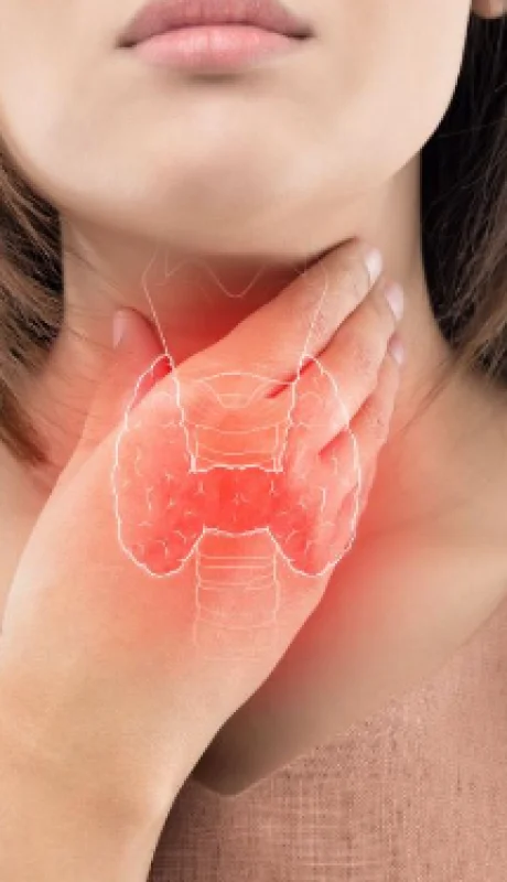 El cáncer de tiroides se puede identificar en el momento que aparecen masas en la zona frontal del cuello.