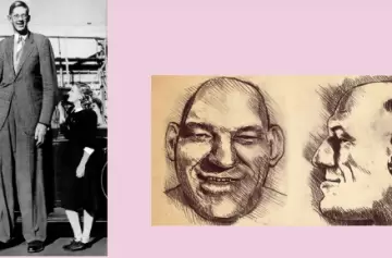 Acromegalia: buenas noticias y consejos para combatir la enfermedad