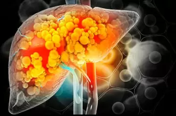 Hígado graso: cuidados, precauciones y formas de combatirlo