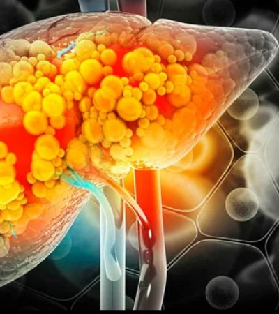 Pocas personas sabes que el hígado graso no alcohólico puede derivar en cirrosis.