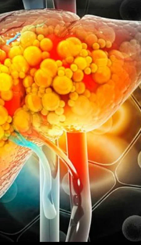 Pocas personas sabes que el hígado graso no alcohólico puede derivar en cirrosis.