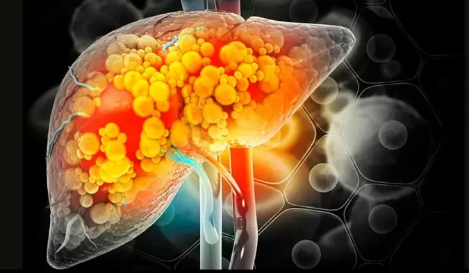 Pocas personas sabes que el hígado graso no alcohólico puede derivar en cirrosis.