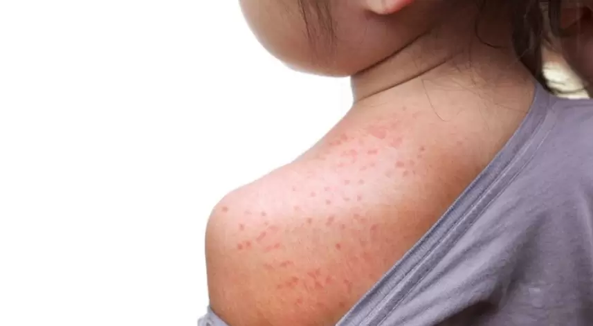 Las petequias pueden aparecer en cualquier parte, aunque más frecuentes en las piernas, los brazos, el rostro, el interior de la boca y los párpados.