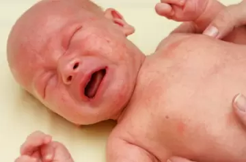 La meningitis puede ser mortal o dejar secuelas irreversibles