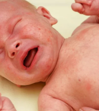 Aunque es cierto que parecen una erupción cutánea, las petequias en realidad son causadas por el sangrado debajo de la piel.