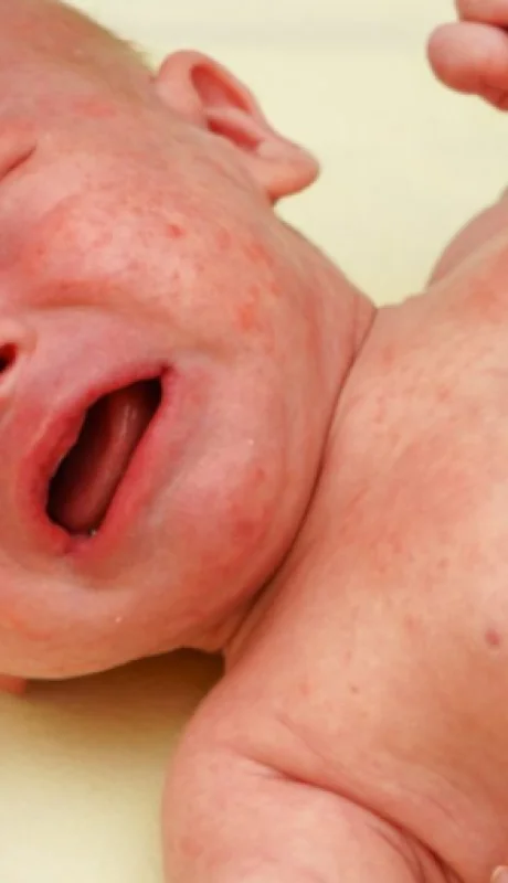 Aunque es cierto que parecen una erupción cutánea, las petequias en realidad son causadas por el sangrado debajo de la piel.