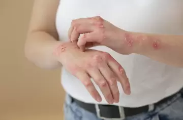 Estrés, genética y psoriasis: cómo se activa y cómo se puede controlar