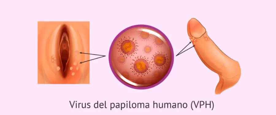 Las verrugas genitales causadas por el virus del papiloma humano (VPH) son pequeñas protuberancias parecidas a una coliflor.