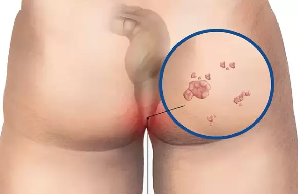 El VPH es la infección de transmisión sexual más común em hombres y mujeres.