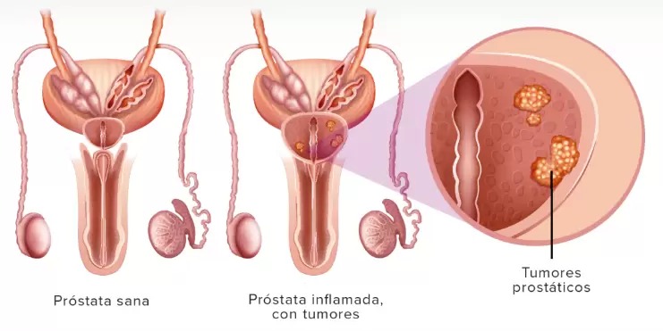 Lo (muy) positivo de este tipo de tumor es que tiene una tasa de curación muy elevada.