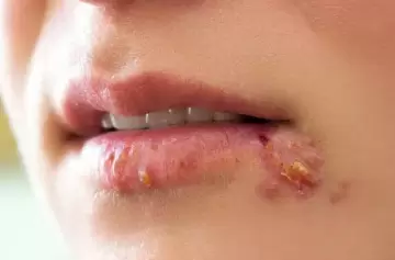 Conocé los tipos de herpesvirus, síntomas y medidas preventivas