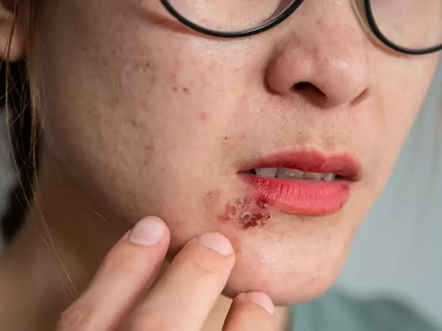 Virus de Epstein-Barr