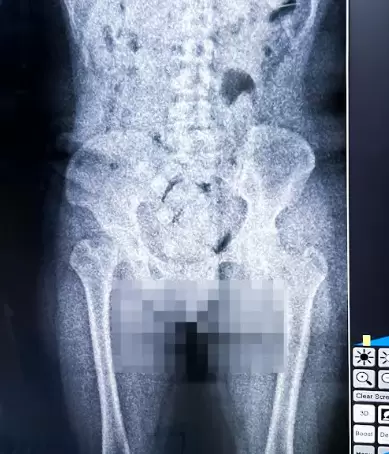 Resultado del escaner corporal practicado al hombre que trató de ingresar al país cocaína en cápsulas dentro de su cuerpo.