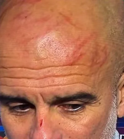 Guardiola se autolastimó.