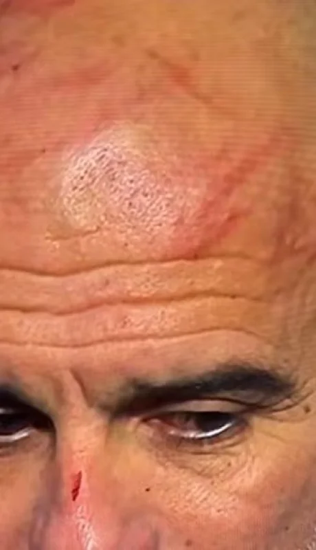 Guardiola se autolastimó.