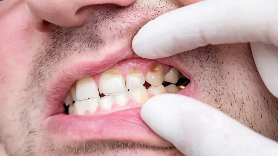 Bicarbonato de sodio y sal: la mezcla milagrosa para evitar el sarro dental.