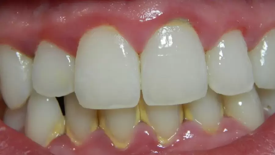 El esmalte es una parte esencial del diente. El bicarbonato, junto con la sal, puede debilitarlo.