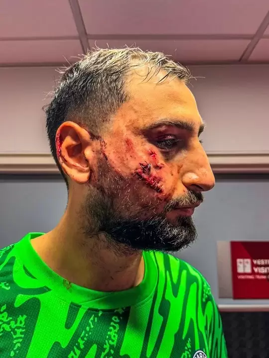 Así quedó el rostro de Donnarumma