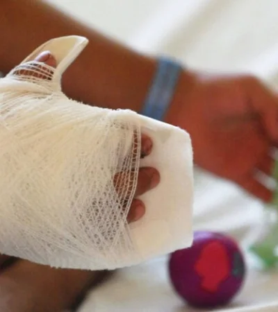 Quemaduras por uso de pirotecnia.