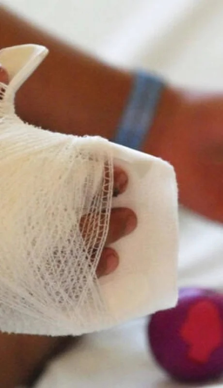 Quemaduras por uso de pirotecnia.